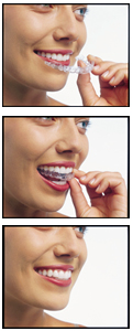 Different Stages in Invisalign Treatment